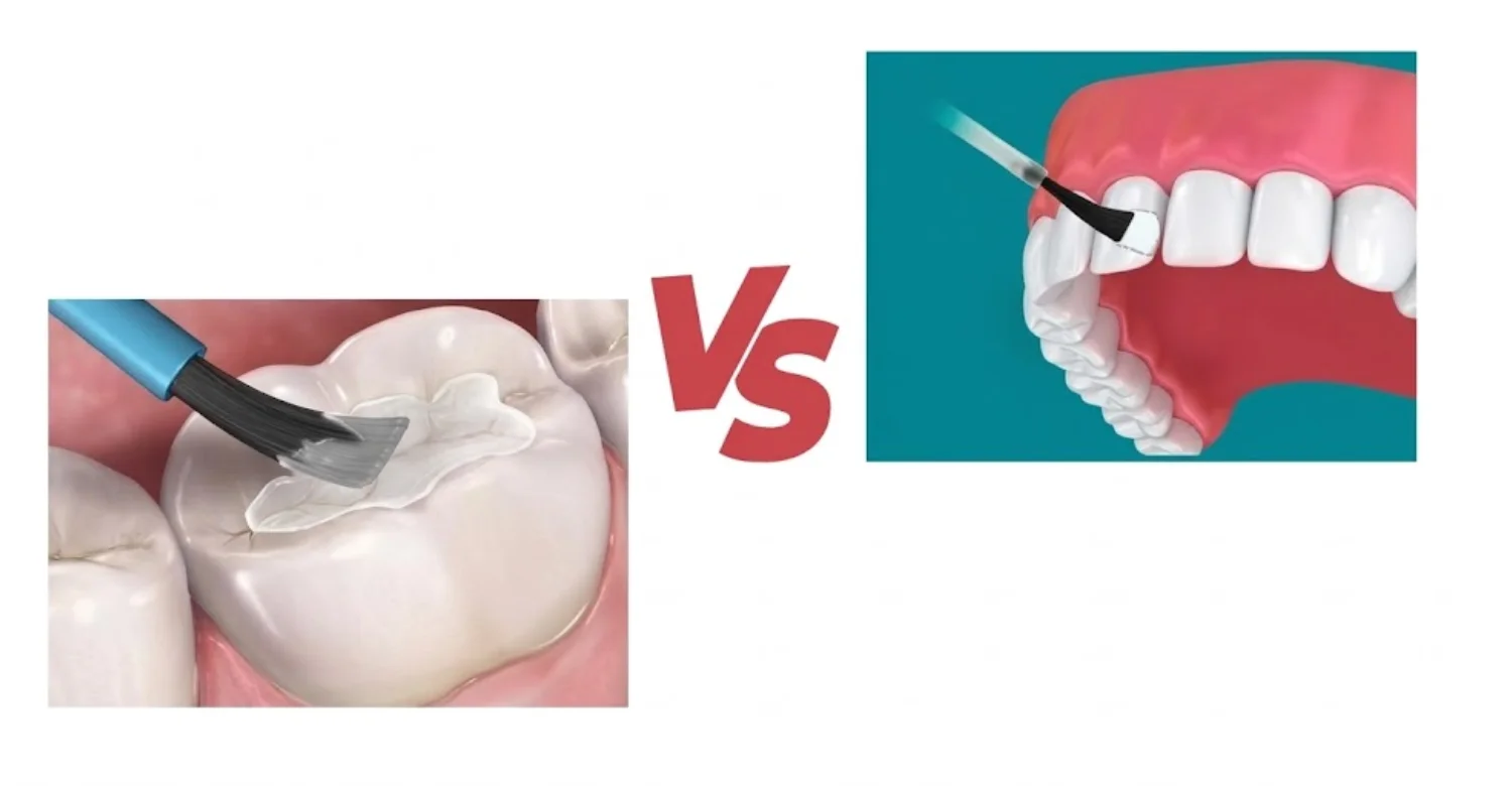 dental sealants vs fluoride treatment1